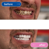 لمینت دندان دو فک مدل TruSmile (اورجینال)
